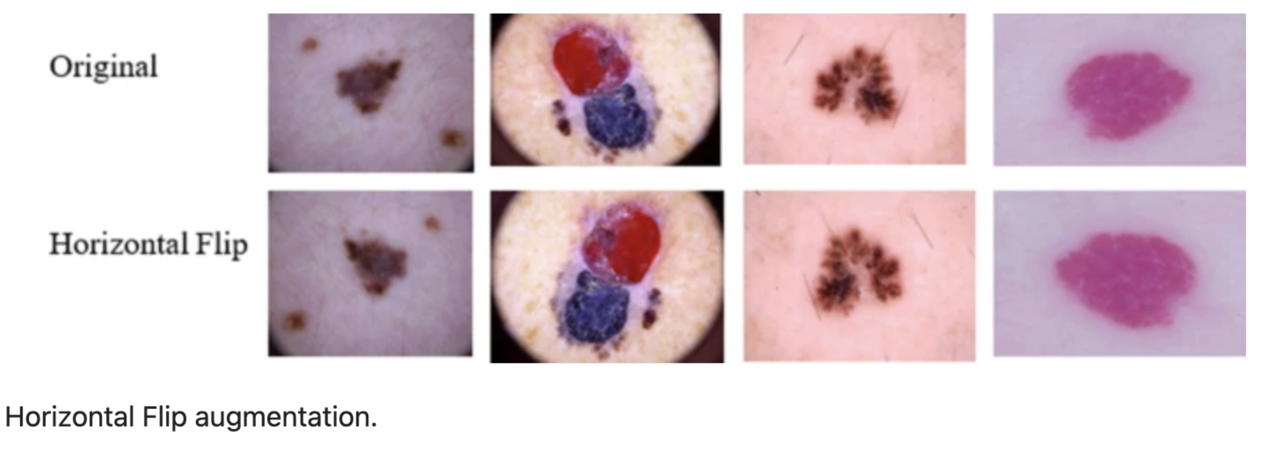 Example of horizontal flip augmentation applied to a skin lesion image.
