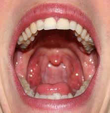 Picture of someone's mouth, showing their teeth and into their oral cavity and throat.
